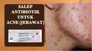 Mengapa Salep Antibiotik Bukan Solusi Untuk Jerawat Ringan Panduan Medis Dan Alternatifnya